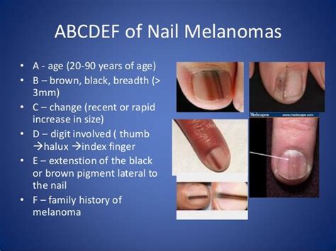 normal black line on nail vs melanoma